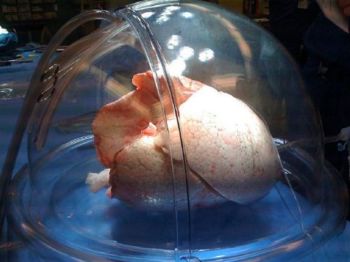 Dr. Shaf Keshavjee weighs in on 2013's biggest medical breakthroughs