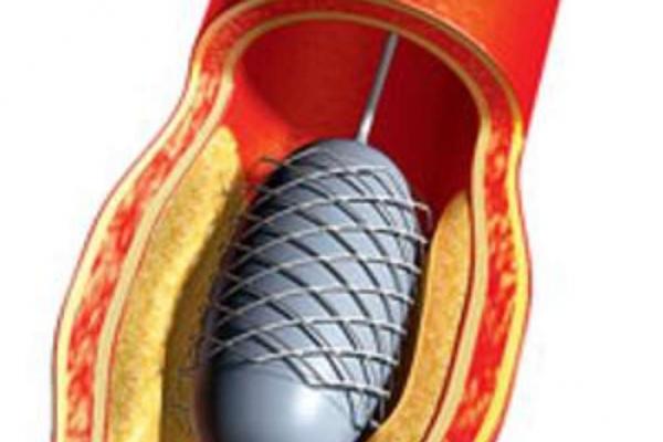 Aga Khan uses diamond drill to clear clogged arteries | The Star