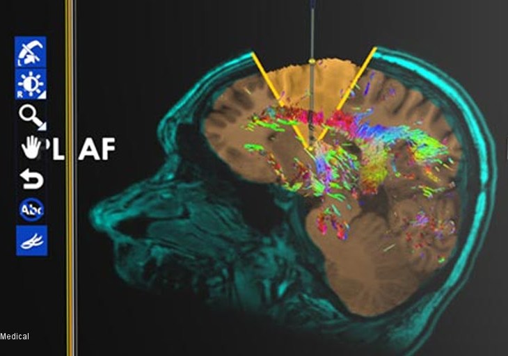 Aga Khan University Hospital becomes the first to introduce advanced equipment for brain surgeries in Pakistan