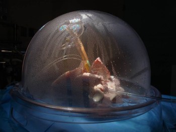 The latest generation ex vivo lung perfusion (EVLP)